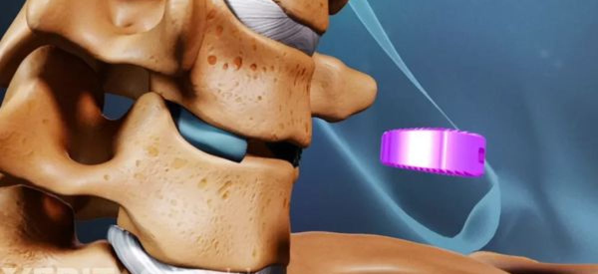 ACDF surgery