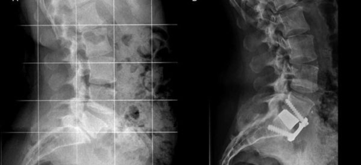 ALIF Surgery