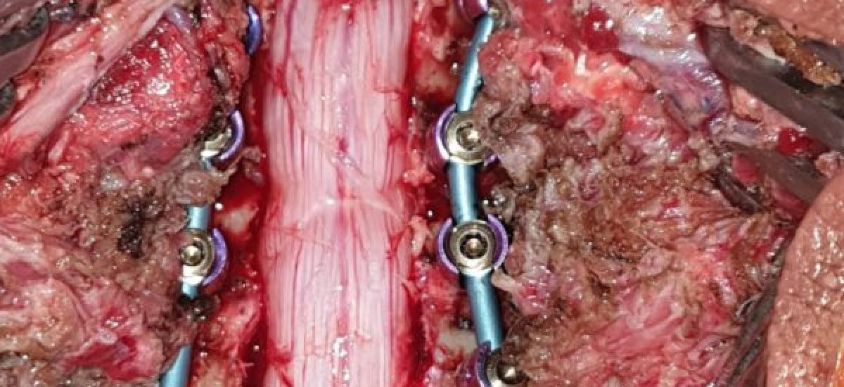 Laminectomy surgery