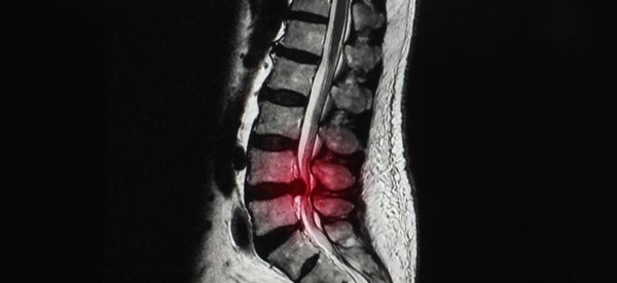 Lumbar Canal Stenosis