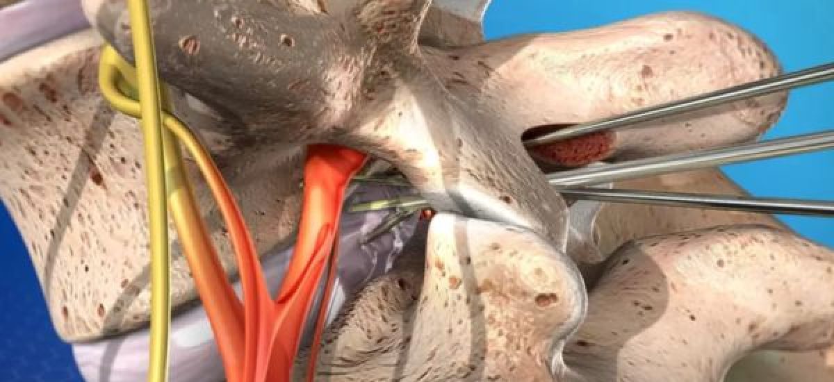 Microdiscectomy surgery