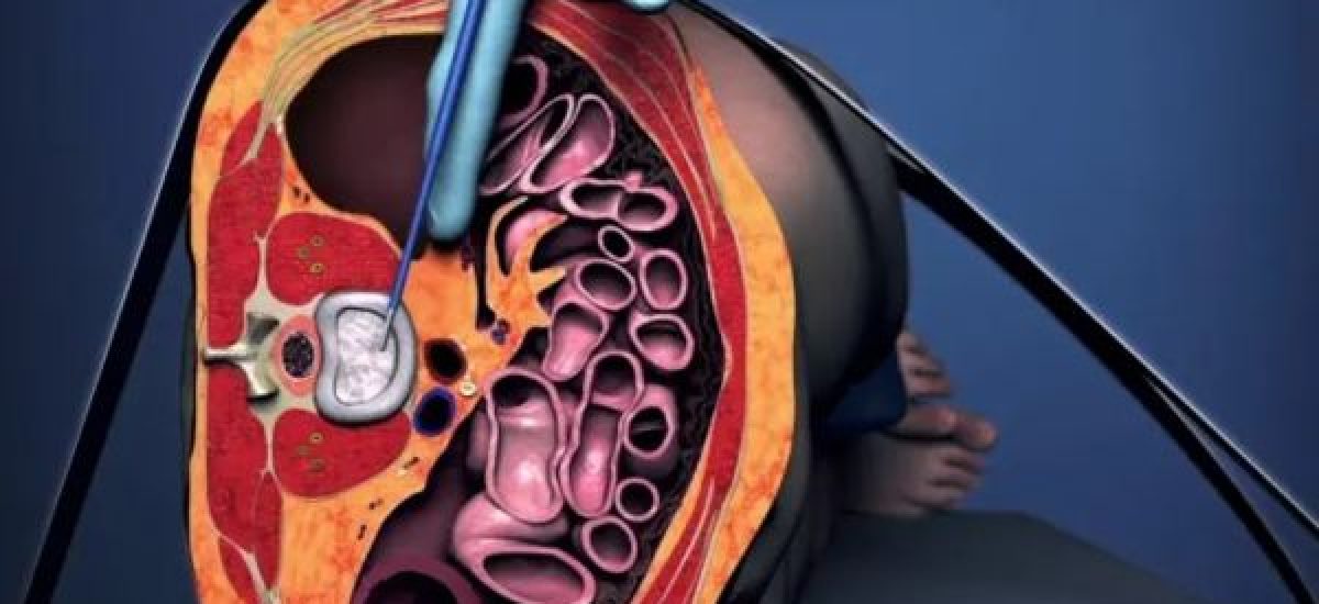 OLIF surgery