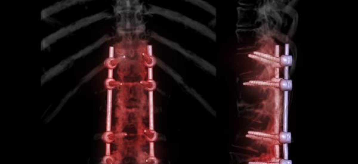 Spinal fusion