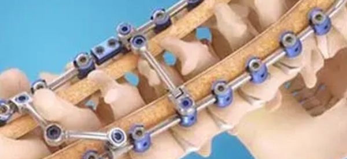 Spinal reconstruction