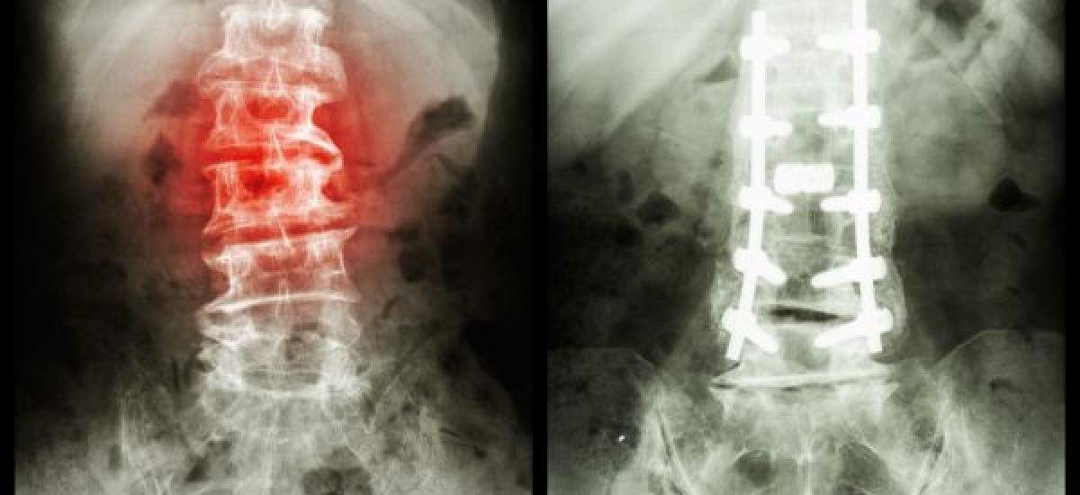 Spondylolisthesis